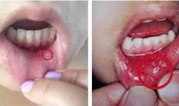 吃网纹瓜口腔疼,口腔不适需注意