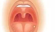 吃网纹瓜口腔疼,口腔不适需注意